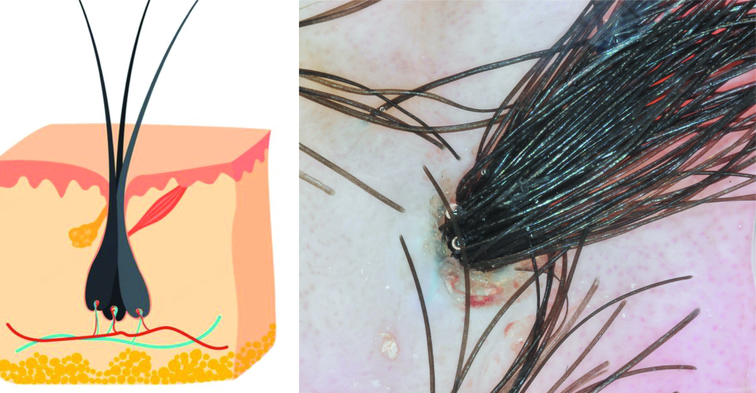 Understanding Multiple Hairs in One Follicle: Causes, Treatments, and Everything You Need to Know