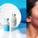 murad deep relief acne treatment